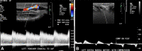Arterial steal syndrome in a 62-year-old woman with right
radiocephalic AVF who presented with hand pain and numbness. (A) Spectral
color Doppler US image of the radial artery cranial to the AVF shows
antegrade flow. (B) Spectral Doppler US image of the radial artery caudal to
the AVF anastomosis shows retrograde flow changing to antegrade flow during
manual compression of the AVF.