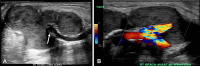 HD access graft–associated fluid collections. (A) Gray-scale US
image of a perigraft hematoma shows a lobular collection with internal echoes
partly surrounding the graft (arrow). (B) Color Doppler US image shows that
there is no blood flow in the collection. A hematoma can appear similar to an
abscess, but this patient had no clinical signs of infection.