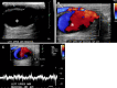 Pseudoaneurysm of the left upper arm AVF in a 64-year-old man. (A)
Gray-scale US image shows a large pseudoaneurysm (*) arising from the
posterior aspect of the AVF (arrow). The dashed line indicates the AVF
defect. (B) Color Doppler US image shows swirling flow (*) within the
pseudoaneurysm. (C) Spectral Doppler US waveform obtained within the
pseudoaneurysm shows a to-and-fro flow pattern (yin-yang sign) owing to
blood flow moving in and out of the pseudoaneurysm.