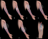 Illustrations show various surgical AVF and AVG sites. (A) Radial
artery–cephalic vein AVF. (B) Brachial artery–cephalic vein
AVF. (C) Brachial artery–transposed basilic vein AVF. (D) Brachial
artery–axillary vein straight AVG. (E) Brachial
artery–axillary vein loop AVG. (F) Brachial artery–cephalic
vein forearm AVG. (G) Lower extremity femoral artery–great saphenous
vein AVG. Arrows = flow direction.