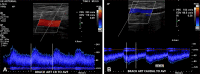 Asymptomatic arterial steal phenomenon in a 54-year-old man with a
left arm brachiocephalic AVF. Doppler US images of the brachial artery
proximal to the AVF (A) show a low-resistance monophasic waveform while the
artery distal to the AVF (B) has reversal of flow, suggesting arterial
steal.