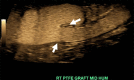 Pseudoaneurysm of the right upper extremity graft in a 35-year-old
woman. B-flow US image shows communication of the pseudoaneurysm with the
graft (arrows).