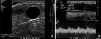 Mature AVF. (A) Transverse gray-scale US image shows the cephalic vein
diameter is greater than 6 mm and depth is less than 6 mm from the skin surface.
(B) Longitudinal US image shows the flow volume measurement is obtained within
the outflow vein 10 cm from the anastomosis and is greater than 600
mL/min.