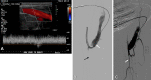 Symptomatic steal syndrome in a 64-year-old man with a left
brachiocephalic AVF and left hand pain. (A) Longitudinal spectral Doppler US
image shows flow reversal in the brachial artery distal to the anastomosis
consistent with steal syndrome. (B) Fistulogram with iodinated contrast
agent shows a dilated tortuous draining vein (white solid arrow) but no
arterial flow distal to the anastomosis (dashed black arrow at the expected
course of the radial artery). (C) Manual compression of the AVF outflow
during angiography shows antegrade flow in the brachial artery (arrow),
distal to the anastomosis. This patient was successfully treated with
surgical banding of the AVF.