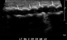 Assessment of arterial calcifications. Longitudinal (LO) gray-scale US
image of the radial artery shows severe atherosclerotic wall calcifications
(arrows) that pose potential difficulty for surgical suturing, possible
increased risk of emboli at surgery, decreased distensibility, and decreased
likelihood to mature due to inadequate arterial inflow. CR = cranial, ID =
internal diameter, WR = wrist.