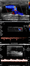 Juxta-anastomotic stenosis treated with percutaneous angioplasty in a
48-year-old man with brachial artery–basilic vein AVF. (A, B) Color
Doppler (A) and spectral Doppler (B) US images at the AVF anastomosis in an
area of focal visual narrowing show the color aliasing and elevated PSV of
286 cm/sec, compared with a brachial artery PSV of 54 cm/sec (not shown),
giving a ratio of 5.2 that is consistent with stenosis. (C) Spectral Doppler
US image shows reduced flow volume in the draining basilic vein of 52
mL/min. Interventional images are shown in Figure S5.