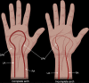 Diagram shows complete (A) and incomplete (B) palmar arches. DPA = deep
palmar arch, RA = radial artery, SPA = superficial palmar arch, UA = ulnar
artery.