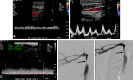 Central venous stenosis in a 55-year-old woman with an AVF of the
right upper extremity. (A, B) Spectral Doppler US images show a monophasic
slow-flow waveform in the right subclavian vein (A), while the contralateral
Internal jugular vein (B) and left subclavian vein (not shown) have normal
phasic waveforms. (C) Spectral Doppler US image shows reduced flow volume at
the venous outflow of the AVF that measures 189 mL/min. (D) Digital
subtraction venogram of the right upper extremity shows moderate to severe
stenosis of the right innominate vein (arrow). (E) Digital subtraction
venogram of the right upper extremity after balloon venoplasty shows no
residual stenosis within the right innominate vein. Posttreatment US (not
shown) showed significant improvement in draining vein flow
volume.