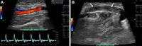Left brachiocephalic AVF thrombosis in a 52-year-old woman with arm
pain and loss of AVF thrill. (A) Longitudinal spectral Doppler US image of
the left brachial artery proximal to the AVF shows a high-resistance
waveform with reversed diastolic flow (“knocking waveform”).
Normally, there is low-resistance flow in the artery proximal to a patent
AVF or AVG anastomosis. (B) Longitudinal spectral Doppler US image of the
left cephalic draining vein shows an avascular echogenic occlusive clot,
with loss of blood flow and spectral waveform in the cephalic
vein.