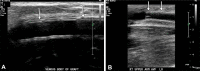 Normal gray-scale appearance of an AVG and vascular stent. (A)
Longitudinal gray-scale US image of the upper extremity AVG shows a distinct
linear echogenicity (arrows) or “tram-track” appearance. (B)
Longitudinal gray-scale US image shows an endovascular stent within the
venous side of an AVF and linear serrated hyperechoic stent wall.