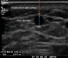 Technique for venous diameter and depth measurement. Transverse gray-scale
US image of the cephalic vein (CV) at the wrist (WR) shows the measurement of
inner diameter (ID) in the anteroposterior dimension (dashed blue line) and the
anterior wall depth from the skin surface (dashed orange arrow).