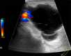 AV access–associated fluid collections. Color Doppler US image of a
seroma near the arterial anastomosis of an AVG shows an anechoic collection with
a few thin septa. Note there is no flow within the collection.