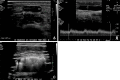 Immature AVF with large accessory veins. (A) Transverse gray-scale US
image of the forearm draining cephalic vein (CV) shows a large accessory vein
(arrow) arising 2 cm from the anastomosis (not shown). (B) Spectral US image of
the flow volume measurement shows a reduced draining vein flow volume of 382
mL/min, measured in the cephalic vein 10 cm from the anastomosis. (C) Gray-scale
US image shows typical shadowing from coils used to occlude the accessory
vein.