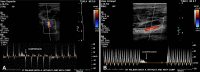 Modified Allen test using Doppler US. (A) US transducer is positioned on
the thenar eminence to measure the superficial palmar artery flow direction
during radial artery compression. Flow reversal during compression indicates a
complete palmar arch, as depicted on this US image. (B) Doppler US image in a
patient with an incomplete palmar arch shows there is no flow reversal in the
obliquely oriented radial artery that occurs during compression since there is
no collateral flow from the ulnar artery through the superficial palmar arch.
White arrow in A and B indicates when compression is applied.