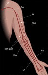 Schematic diagram shows the normal arterial anatomy of the left upper
extremity. AA = axillary artery, BA = brachial artery, CIA = common interosseous
artery, DBA = deep brachial artery, RA = radial artery, RRA = radial recurrent
artery, SA = subclavian artery, UA = ulnar artery, URA = ulnar recurrent
artery.