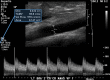 Technique used for blood flow volume measurement. Longitudinal US image at
a straight segment of the vessel identifies an area without turbulent flow
(color Doppler spectrum not shown). The Doppler gate is increased in size to
encompass the entire vessel diameter and is corrected to an angle of 60 degrees
or less, parallel to the posterior vessel wall. Only the antegrade flow is
measured.