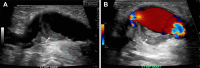 Left brachiocephalic aneurysm in a 75-year-old man. (A) Longitudinal
gray-scale US image shows aneurysmal dilatation involving all three layers
of the vessel wall at the anastomosis, with an area of nonocclusive
eccentric intramural thrombus (arrow). (B) Color Doppler US image shows flow
within the aneurysm with eccentric mural thrombus (arrow). The ratio of
aneurysm size (20 mm) to the outflow vein diameter (6 mm; measurement not
shown) is 3:3.