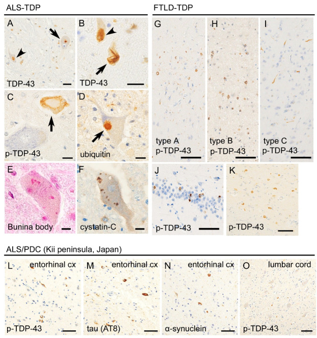 Pathway from TDP-43-Related Pathology to Neuronal Dysfunction in ...