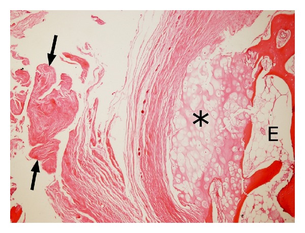 Adventitious Bursitis Overlying an Osteochondroma of the Humerus Facing ...