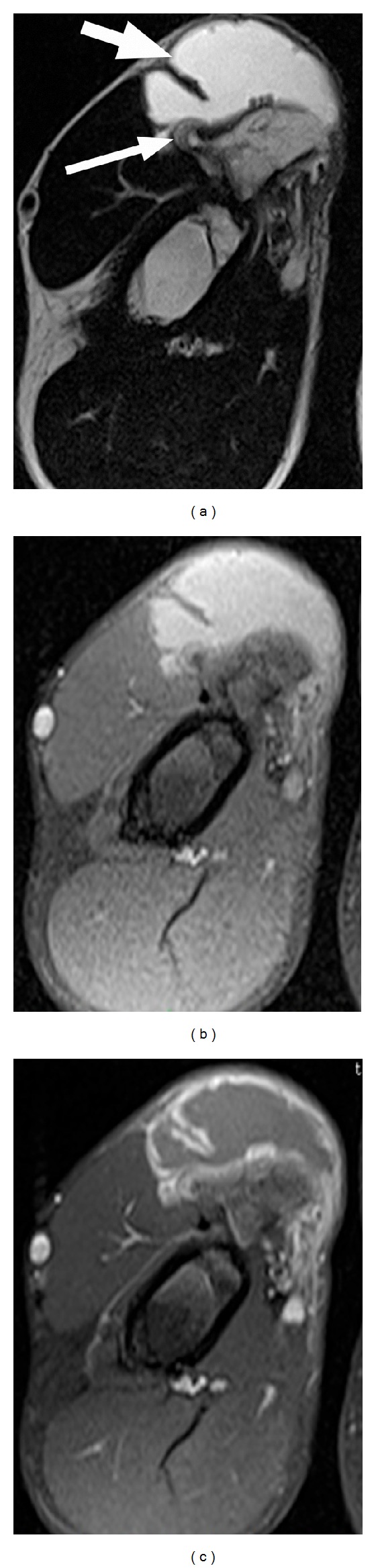 Adventitious Bursitis Overlying an Osteochondroma of the Humerus Facing ...