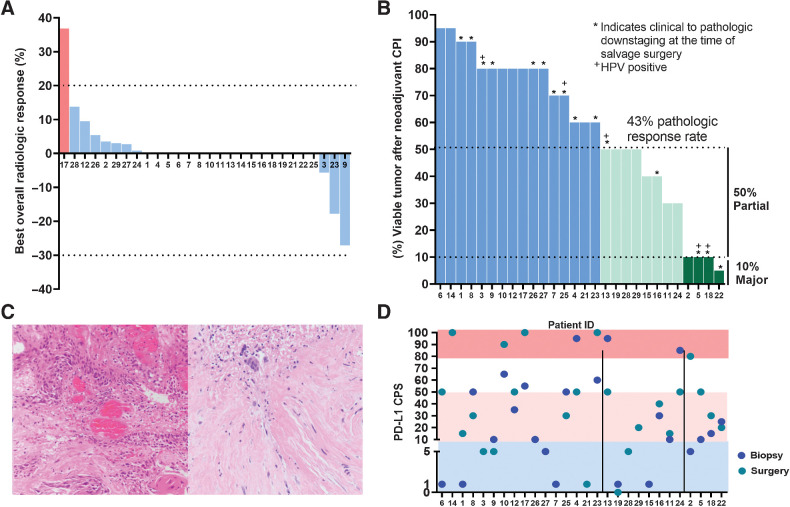 Figure 2. A, Waterfall plot showing objective radiologic response rate to one dose of neoadjuvant nivolumab plus lirilumab in patients with relapsed, resectable SCCHN (RECIST v1.1). B, Viable tumor quantification (%) at the time of salvage surgery following neoadjuvant immunotherapy, arranged by degree of pathologic response (≤50%, partial response; ≤10% major response). HPV, human papillomavirus. C, Preimmunotherapy right posterior tongue biopsy (patient ID #22) showing keratinizing, invasive squamous cell carcinoma (200×; left) and a post-op hemi-glossectomy specimen with extensive fibrosis in the prior tumor bed with an area of necrosis and a few multinucleated giant cells noted in the upper left region (200×; right). D, Tumor and immune cell PD-L1 expression CPS in both the initial preimmunotherapy recurrence specimen and paired salvage tumor specimen, arranged by descending % tumor viability.