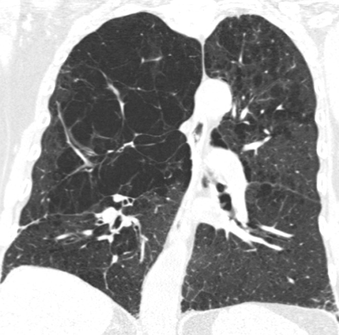 Coronal CT images show progressive grades of parenchymal emphysema on the basis of the Fleischner classification system. (a) Normal CT scan shows no emphysema. (b) Trace centrilobular emphysema (circles). (c) Mild centrilobular emphysema (arrows). (d) Moderate centrilobular emphysema involving more than 5% of the lung zone. (e) Confluent emphysema. (f) Advanced destructive emphysema.