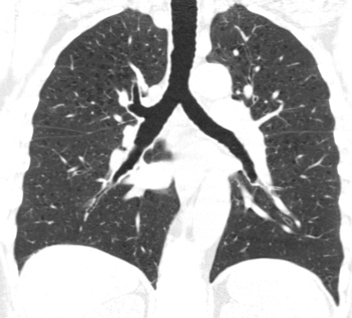 Baseline and 5-year follow up inspiratory CT scans in two Global Initiative for Chronic Obstructive Lung Disease stage 0 participants showing no progression and progression. (a) Baseline and (b) 5-year follow-up scans in a 55-year-old female participant without visually evident emphysema and no interval progression at follow-up. Forced expiratory volume in 1 second (FEV1) decreased by 62 mL. (c) Baseline and (d) 5-year follow-up scans in a 49-year-old male participant with trace emphysema at baseline but progression to moderate emphysema at follow-up. FEV1 decreased by 780 mL between visits.