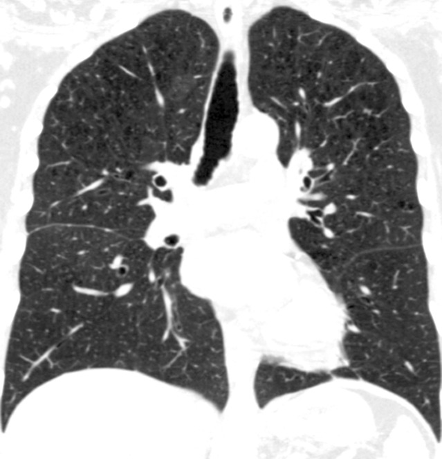 Coronal CT images show progressive grades of parenchymal emphysema on the basis of the Fleischner classification system. (a) Normal CT scan shows no emphysema. (b) Trace centrilobular emphysema (circles). (c) Mild centrilobular emphysema (arrows). (d) Moderate centrilobular emphysema involving more than 5% of the lung zone. (e) Confluent emphysema. (f) Advanced destructive emphysema.