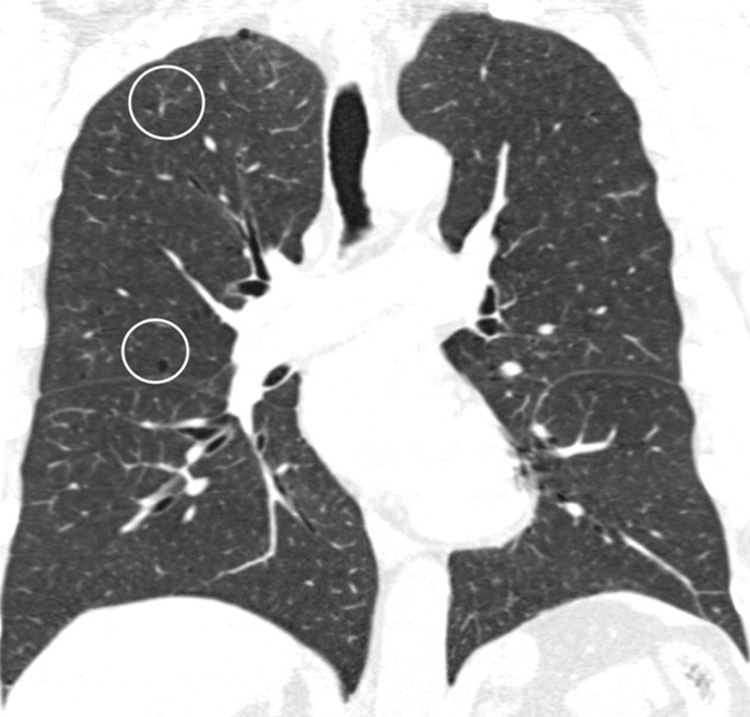 Coronal CT images show progressive grades of parenchymal emphysema on the basis of the Fleischner classification system. (a) Normal CT scan shows no emphysema. (b) Trace centrilobular emphysema (circles). (c) Mild centrilobular emphysema (arrows). (d) Moderate centrilobular emphysema involving more than 5% of the lung zone. (e) Confluent emphysema. (f) Advanced destructive emphysema.