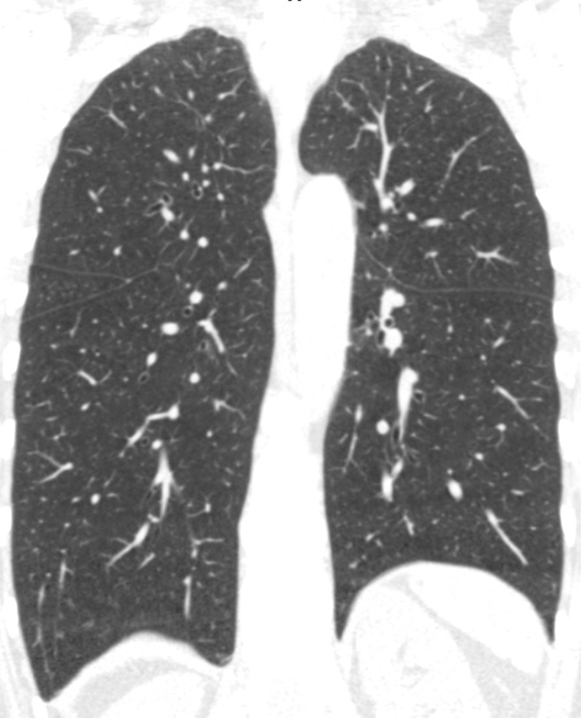 Baseline and 5-year follow up inspiratory CT scans in two Global Initiative for Chronic Obstructive Lung Disease stage 0 participants showing no progression and progression. (a) Baseline and (b) 5-year follow-up scans in a 55-year-old female participant without visually evident emphysema and no interval progression at follow-up. Forced expiratory volume in 1 second (FEV1) decreased by 62 mL. (c) Baseline and (d) 5-year follow-up scans in a 49-year-old male participant with trace emphysema at baseline but progression to moderate emphysema at follow-up. FEV1 decreased by 780 mL between visits.