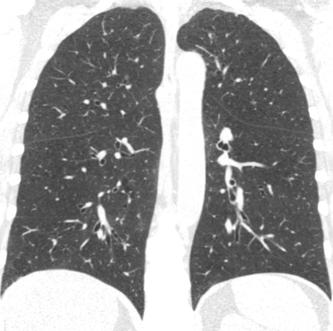 Coronal CT images show progressive grades of parenchymal emphysema on the basis of the Fleischner classification system. (a) Normal CT scan shows no emphysema. (b) Trace centrilobular emphysema (circles). (c) Mild centrilobular emphysema (arrows). (d) Moderate centrilobular emphysema involving more than 5% of the lung zone. (e) Confluent emphysema. (f) Advanced destructive emphysema.