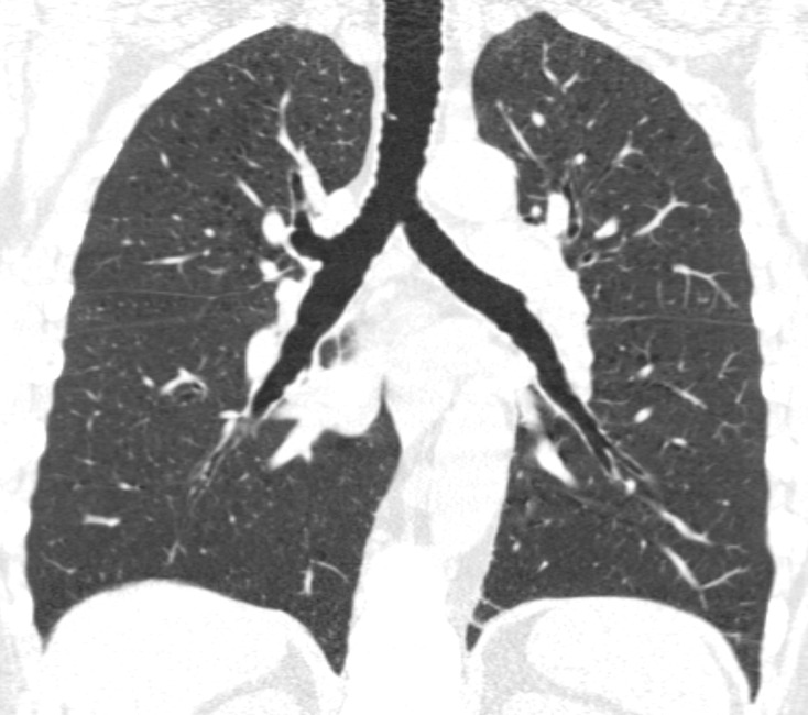 Baseline and 5-year follow up inspiratory CT scans in two Global Initiative for Chronic Obstructive Lung Disease stage 0 participants showing no progression and progression. (a) Baseline and (b) 5-year follow-up scans in a 55-year-old female participant without visually evident emphysema and no interval progression at follow-up. Forced expiratory volume in 1 second (FEV1) decreased by 62 mL. (c) Baseline and (d) 5-year follow-up scans in a 49-year-old male participant with trace emphysema at baseline but progression to moderate emphysema at follow-up. FEV1 decreased by 780 mL between visits.