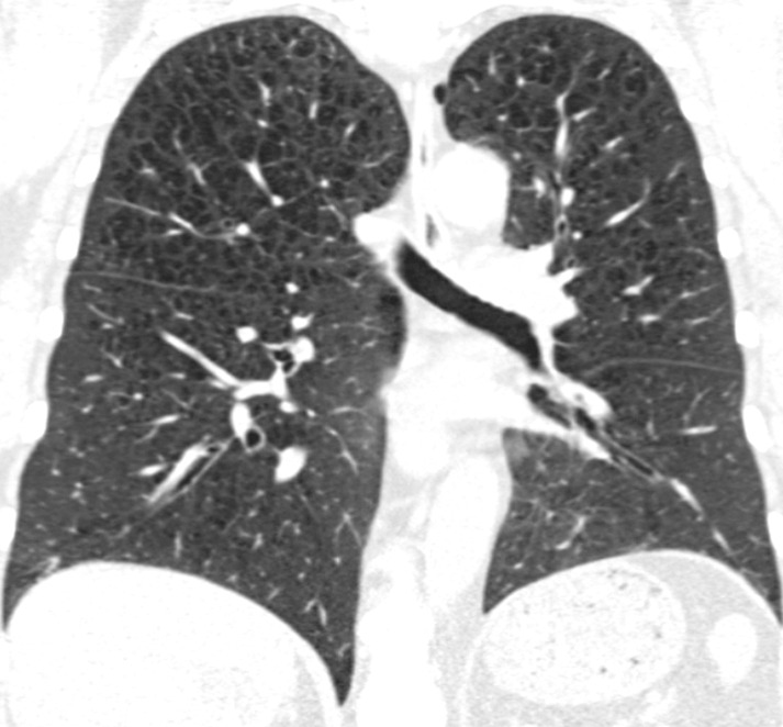 Coronal CT images show progressive grades of parenchymal emphysema on the basis of the Fleischner classification system. (a) Normal CT scan shows no emphysema. (b) Trace centrilobular emphysema (circles). (c) Mild centrilobular emphysema (arrows). (d) Moderate centrilobular emphysema involving more than 5% of the lung zone. (e) Confluent emphysema. (f) Advanced destructive emphysema.