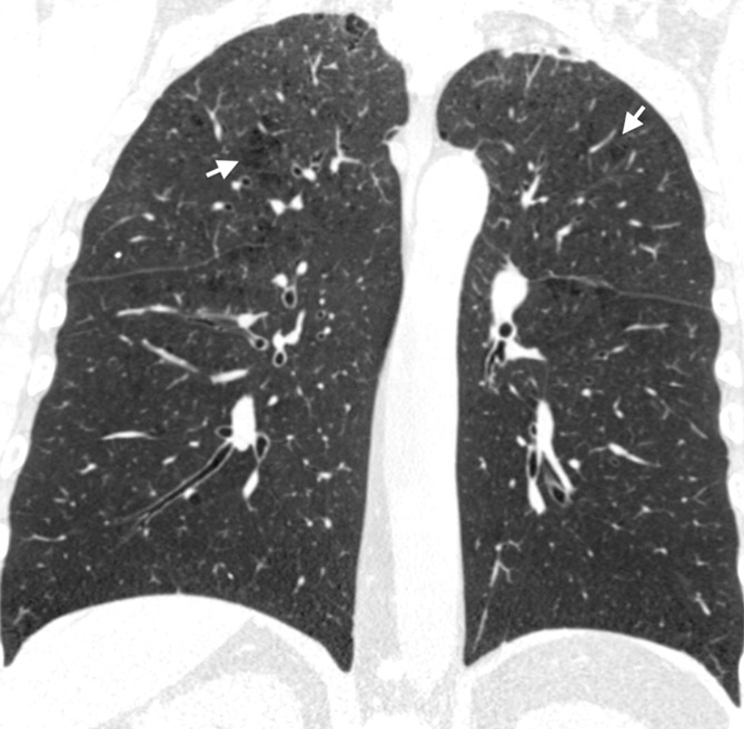 Coronal CT images show progressive grades of parenchymal emphysema on the basis of the Fleischner classification system. (a) Normal CT scan shows no emphysema. (b) Trace centrilobular emphysema (circles). (c) Mild centrilobular emphysema (arrows). (d) Moderate centrilobular emphysema involving more than 5% of the lung zone. (e) Confluent emphysema. (f) Advanced destructive emphysema.