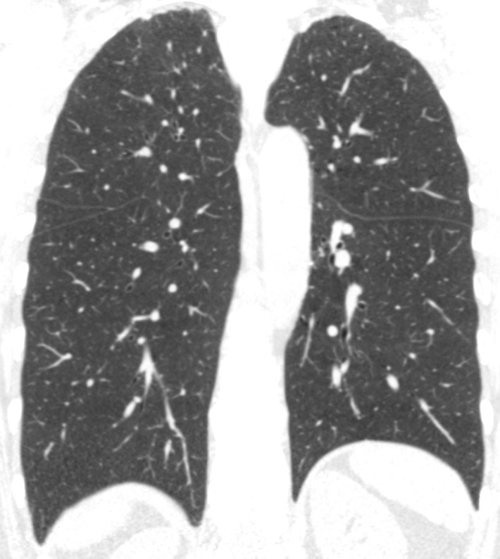 Baseline and 5-year follow up inspiratory CT scans in two Global Initiative for Chronic Obstructive Lung Disease stage 0 participants showing no progression and progression. (a) Baseline and (b) 5-year follow-up scans in a 55-year-old female participant without visually evident emphysema and no interval progression at follow-up. Forced expiratory volume in 1 second (FEV1) decreased by 62 mL. (c) Baseline and (d) 5-year follow-up scans in a 49-year-old male participant with trace emphysema at baseline but progression to moderate emphysema at follow-up. FEV1 decreased by 780 mL between visits.