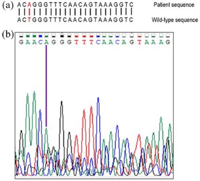 Fructosuria and recurrent hypoglycemia in a patient with a novel c ...