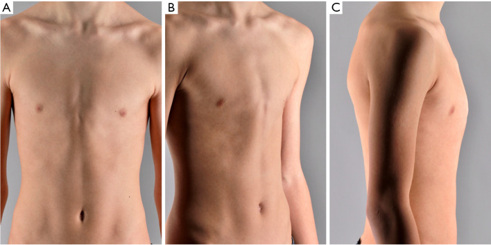 Pectus excavatum and carinatum: a narrative review of epidemiology ...