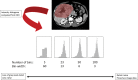 SI discretization involves assigning pixels within a given SI range to a
single value or bin and is used before calculation of second-order features. In
this diagram, the SI histogram is derived from an ROI encompassing a hepatic
tumor with varying bin size (or bin width). Increasing the bin size or
decreasing the number of bins may cause loss of image detail but reduces noise,
whereas decreasing the bin size or increasing the number of bins preserves image
detail at the expense of image noise. The choice of image modality and SI range
will define the method of discretization.