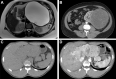 Variations in tumor heterogeneity from less to more heterogeneous are
demonstrated in these abdominal masses. (A) Axial T2-weighted MR image in a
40-year-old woman shows a large unilocular cystic lesion in the pancreas that
appears to have uniform high signal intensity (SI), with only minor nonenhancing
peripheral septa and a smooth border. This appearance is typical for a mucinous
cystadenoma. After surgical resection, no invasive malignancy was found. (B)
Axial CT image shows a partly heterogeneous mass in the left kidney, which
appears well defined and contains predominantly homogeneous bland-appearing
tissue with streaks of vascularity. This was found to be a spindle-cell sarcoma
after surgical resection. (C, D) Axial nonenhanced (C) and contrast-enhanced (D)
CT images of a fibrolamellar hepatocellular carcinoma clearly show the
heterogeneous nature of this malignant tumor, with irregular vascular enhancing
tissue surrounding a less-vascular central component. Contrast-enhanced imaging
is often used in radiomic analyses and is useful to help highlight vascularity
and spatial heterogeneity, a determinant of tumor behavior and resistance to
therapy that is not readily apparent without contrast material. 