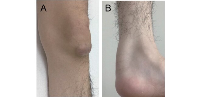 Fig.3. Xanthomas in a patient with CTX