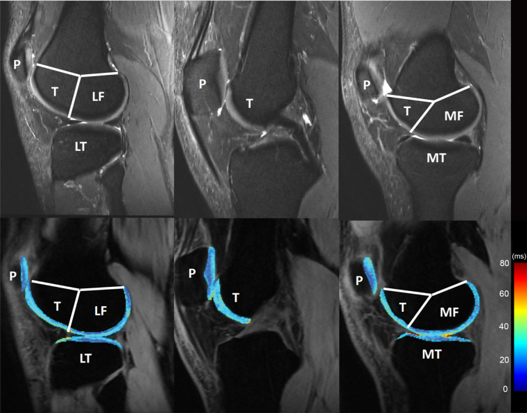 Knee cartilage compartments with anatomic labels implemented in lateral (left side), central (middle), and medial (right side) MRI obtained with an intermediate weighted fat-saturated fast-spin-echo sequence (top row) and a spin-lattice relaxation time constant in rotating frame (T1ρ) magnetization-prepared angle-modulated partitioned k-space spoiled gradient echo snapshots sequence (bottom row, T1ρ maps). Study was performed without administration of intravenous gadolinium-based contrast material. The lateral femur (LF)/medial femur (MF) and lateral tibia (LT)/medial tibia (MT) can be further divided into subcompartments on the basis of meniscus anatomy according to Eckstein et al. Source.—Reference 53. P = patella, T = trochlea.