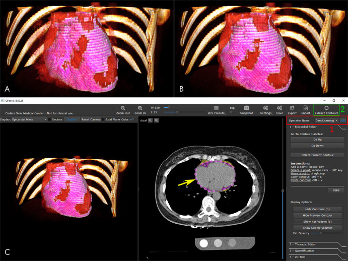 Deep learning–based quantification of epicardial adipose tissue. A, Three-dimensional rendering of epicardial adipose tissue (pink overlay) derived from coronary artery calcium scoring CT, B, as manually measured by an expert, and C, as automatically quantified by a deep learning algorithm embedded in research software (QFAT [version 2.0; Cedars-Sinai Medical Center]). (Reprinted, with permission, from reference 12.)