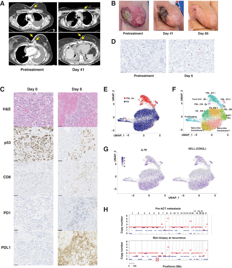 Figure 4. ACT with R175H-TCR–engineered autologous PBLs for the treatment of patient 4349 with chemorefractory breast cancer. A, Contrast-enhanced CT scans of the chest of patient 4349 before (left) and day 41 after the infusion of 5.3 × 1010 R175H-TCR–expressing PBLs (right). B, Pictures showing changes in metastatic skin deposits before the cell therapy (left), at day 41 (middle), and day 60 (right). C,) IHC analysis of the skin biopsies at day 0 before the cell therapy (left) and at day 6 (right). Scale bar, 100 μm. Following ACT, a decrease in tumor cell numbers and p53+ tumor cells and an increase in CD8+ T cells, PD-1+ T cells, and PD-L1+ tumor cells were detected. D, Detection of R175H-TCR+ T cells by RNAscope. Tumor-infiltrating T cells that expressed the R175H-TCR are visualized using an RNAscope probe against the MSGV1 3′ UTR. Each purple dot represents one RNA molecule. UMAP projection of 12,993 R175H-TCR+CD8+ T cells: 10,893 infusion product T cells (RX) and 2,100 6-week posttreatment PBLs (PBL_6w). E, UMAP clustering of single cells indicated by the sample source. F, Clustering based on whole transcriptome analysis. Phenotypic clusters are represented using different colors. G, Expression of indicated genes overlaid on the UMAP projection of RX cells and PBL_6w cells. H, Copy-number analysis of patient 4349′s pre-ACT metastasis tumor fragment 6 (top) and the skin biopsy at recurrence (bottom) by WES. LOH of chromosome 6 containing HLA-A*02:01 is highlighted in a red box. H&E, hematoxylin and eosin; Eff, effector T cells; EM, effector memory T cells; CM, central memory T cells; Term Exh, terminally exhausted T cells; MAIT, mucosa-associated invariant T cells.