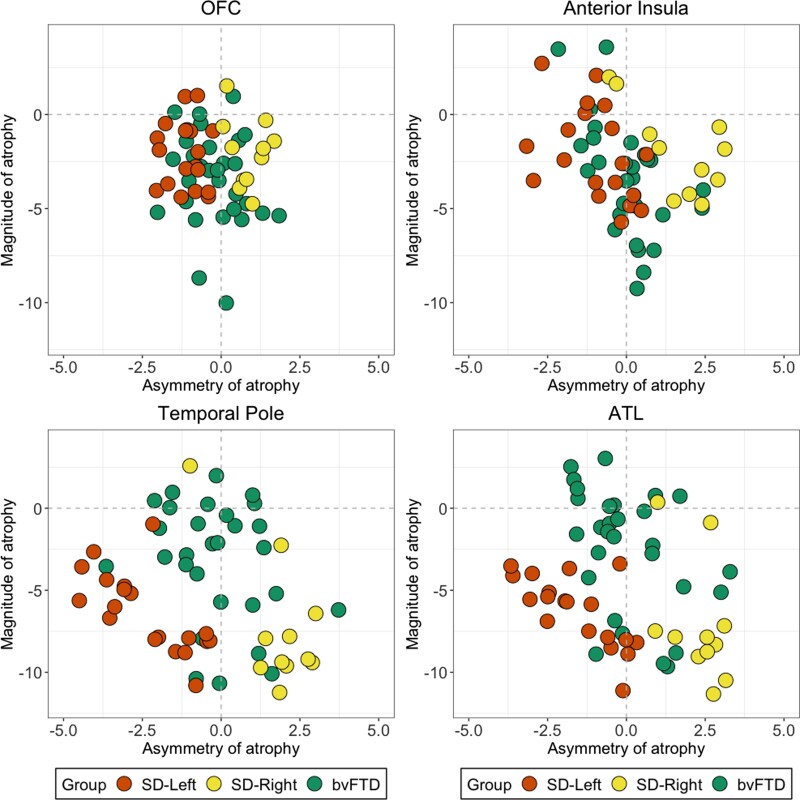 Figure 1 Variance in the magnitude and asymmetry of atrophy in bvFTD and SD in disease-specific epicentres.