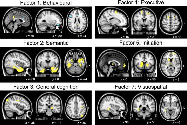 Figure 5 Regions of grey matter intensity correlating with PCA-generated factors in the patient cohort.