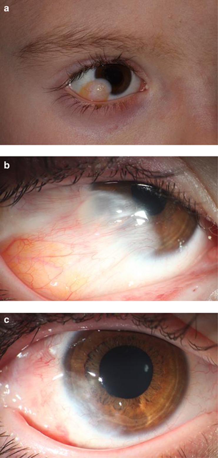 Surgical management of corneal limbal dermoids: retrospective study of ...