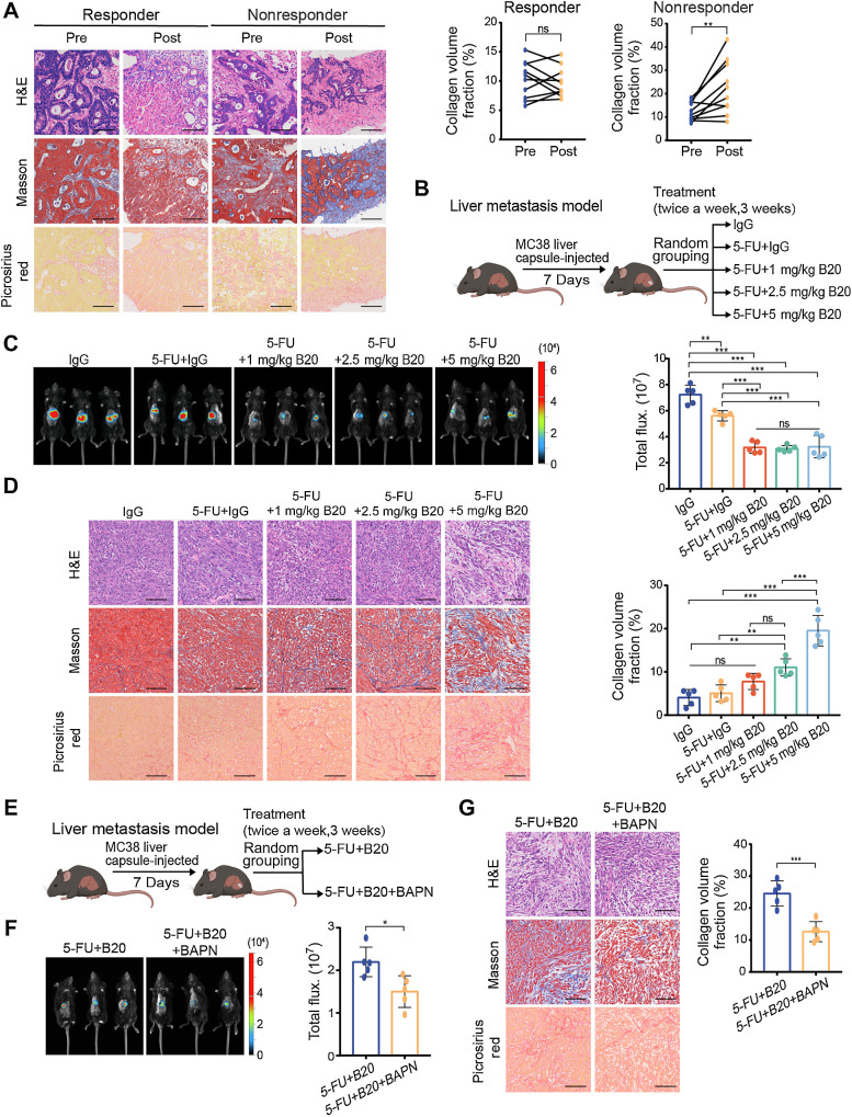 Figure 1. Bevacizumab increases ECM deposition in colorectal cancer liver metastases in a dose-dependent manner. A, Representative hematoxylin and eosin (H&E), Masson and picrosirius red (left) on serial sections showing ECM deposition change in liver metastases from patients with colorectal cancer before and after receiving chemotherapy and bevacizumab treatment. Quantification of intraindividual comparisons of collagen volume fraction (right) in paired samples (two-tailed paired t test; n = 10 per group). B, Schematic representation of the liver metastasis models used in C and D. Mice were given treatment with control IgG, 5-FU+IgG, 5-FU+1 mg/kg B20, 5-FU+2.5 mg/kg B20 or 5-FU+5 mg/kg B20 (5-FU 50 mg/kg; twice a week, 3 weeks). C, Representative in vivo bioluminescent images (left) and quantification of bioluminescent signals (right) of liver metastases in mice with indicated treatment (one-way ANOVA; n = 5 per group). D, Representative hematoxylin and eosin, Masson, picrosirius red images (left) on serial sections and quantification of collagen volume fraction (right) showing ECM deposition in liver metastases in mice with indicated treatment (one-way ANOVA; n = 5 per group). E, Schematic representation of the liver metastasis models used in F and G. Mice were administered 5-FU+B20 or 5-FU+B20+BAPN (5-FU, 50 mg/kg; B20, 5 mg/kg; BAPN, 100 mg/kg; twice a week, 3 weeks). F, Representative in vivo bioluminescent images (left) and quantification of bioluminescent signals (right) of liver metastases in mice with indicated treatment (two-tailed unpaired t test; n = 5 per group). G, Representative hematoxylin and eosin, Masson, picrosirius red images (left), and quantification of collagen volume fraction (right) showing ECM deposition in liver metastases in mice with indicated treatment (two-tailed unpaired t test; n = 5 per group). Data are graphed as the mean ± SD. Scale bar, 100 μm. ns, not significant; P > 0.05; *, P < 0.05; **, P < 0.01; ***, P < 0.001. (B and E, Created with BioRender.com.)