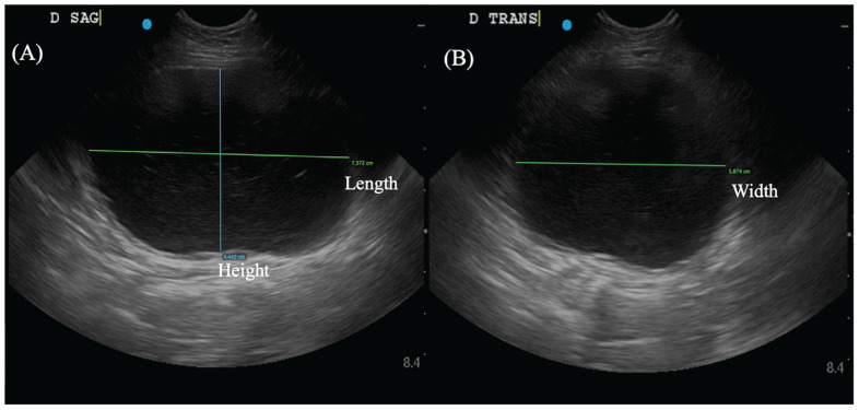 Comparison of estimations of urinary bladder volume in different ...