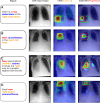 Visual evaluation of twin Anatomy-Guided chest x-ray Network (AGXNet) saliency maps. Column 1: sentences with progression labels (triplets); column 2: frontal chest radiographs; column 3: anatomy network class activation maps (CAMs); column 4: gradient-weighted class activation maps (GradCAM) for new pathologic conditions. Examples for (A) atelectasis, (B) consolidation, (C) edema, and (D) pneumothorax. Green boxes: reference standard anatomic landmarks; orange boxes: generated anatomic bounding box; red boxes: generated bounding box for new progression detection.