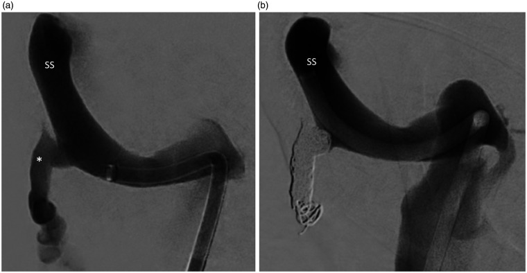 Endovascular coiling of large mastoid emissary vein causing pulsatile ...